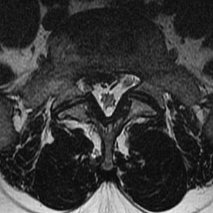 Herniated disc lateral Recess S1 nerve root compression